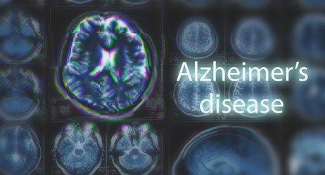 alzheimer's disease