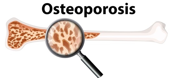 TREATMENT FOR OSTEOPOROSIS