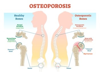 treatment for osteoporosis