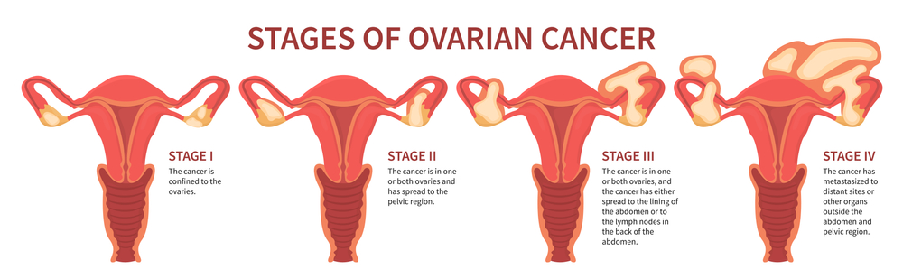 stages of ovarian cancer