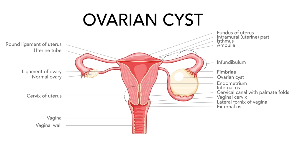 treatment of ovarian cyst 